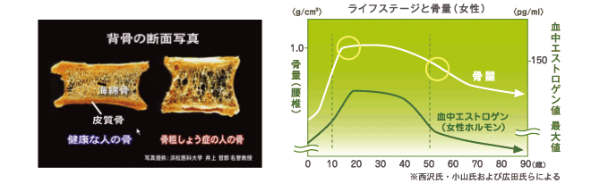 骨粗鬆（しょう）症